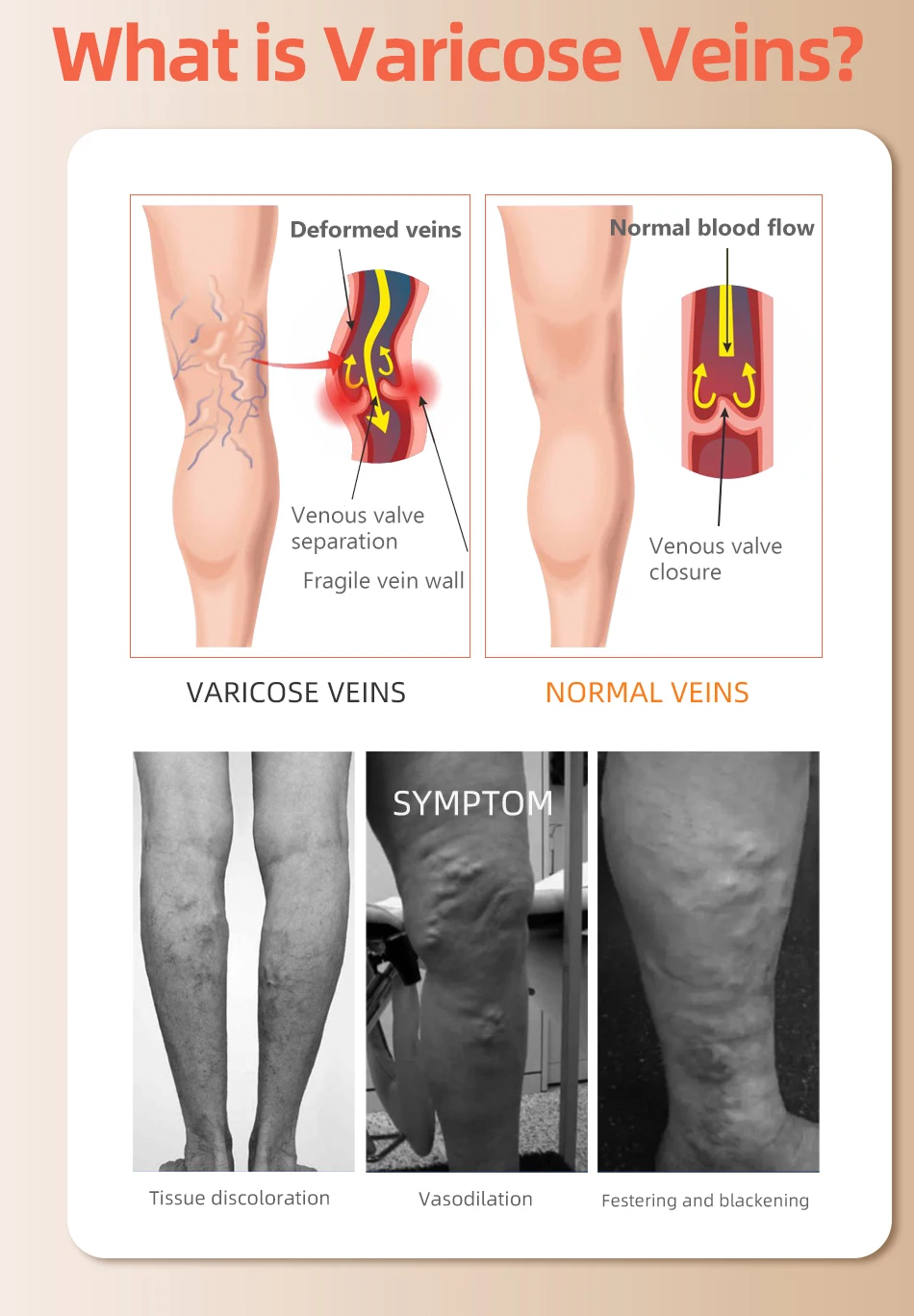 30-40 MmHg Over Knee Closed To - Compression Sock Medical บทวิจารณ์และราคา